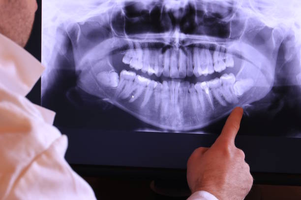 Best Emergency Wisdom Teeth Removal in Delphi, IN